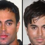 Enrique Iglesias mole before and after removal