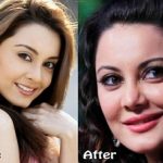 Minissha Surgery Before After