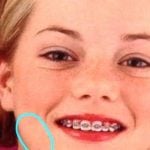 Emma Stone braces