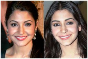 Anushka Sharma before and after plastic surgery
