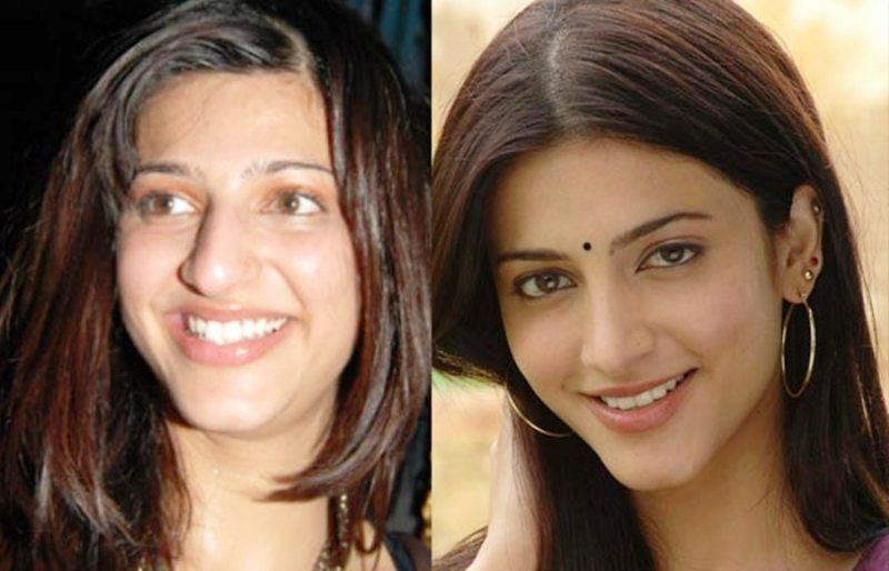 Shruti Haasan Before and After Plastic Surgery