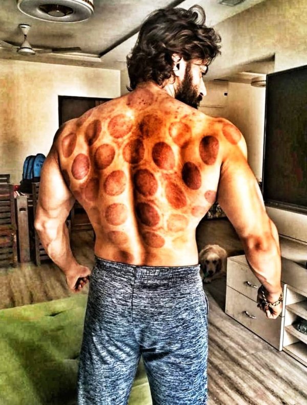 A photo of Shaleen after cupping therapy