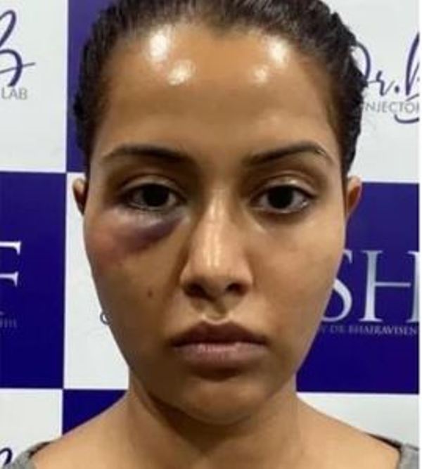 Raiza Wilson's facial treatment that went wrong