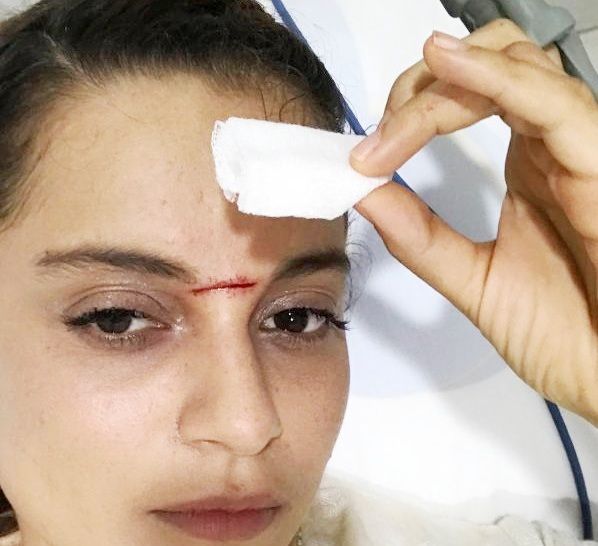 Kangana Ranaut's Stitches