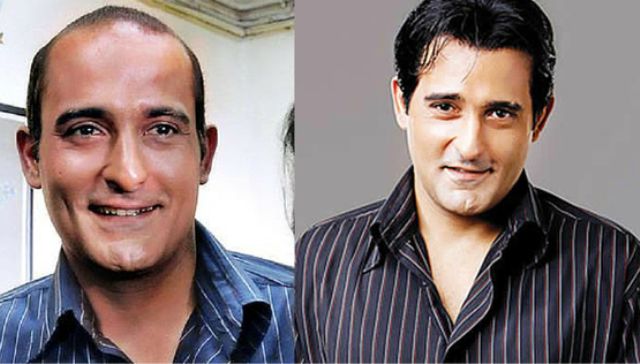 Who are the bald actors in Bollywood opted for hair transplant or wears  wig  Quora