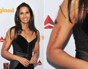 Padma Lakshmi's Arm Scar