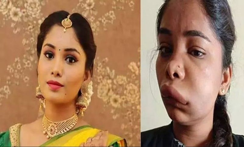 Swathi Sathish face before root canal and after root canal