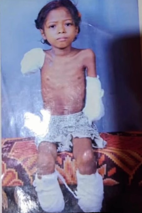 A childhood picture of Payal Nag after her hands and legs were removed