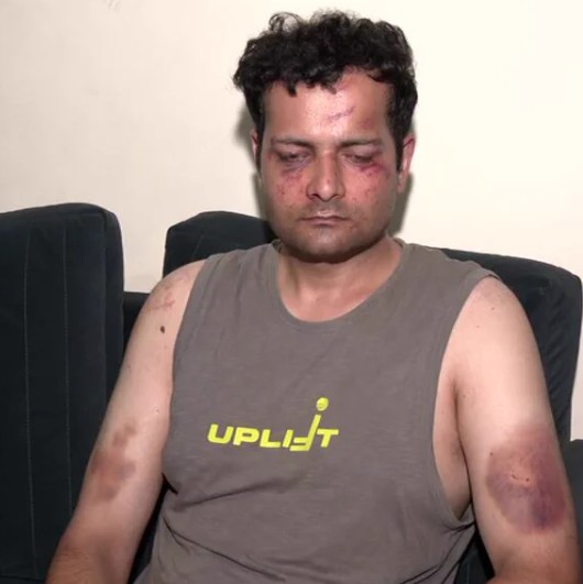 Injured Vivek Bhagat during the clashes that happened during the protests which were held near Jantar Mantar and Connaught Place in July 2026